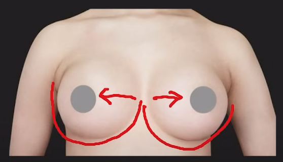가슴 성형 모양